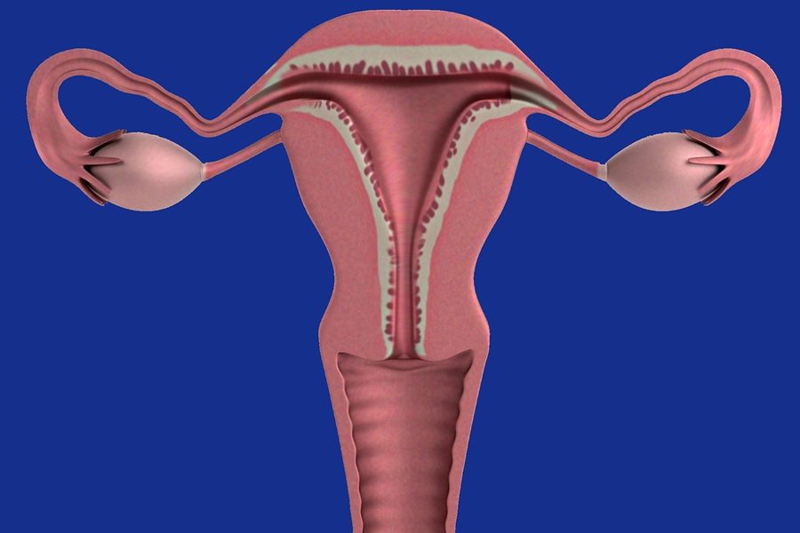 endometriosis, ¿qué es la endometriosis?, síntomas de la endometriosis, diagnóstico de la endometriosis, tratamiento de la endometriosis, causas de endometriosis,