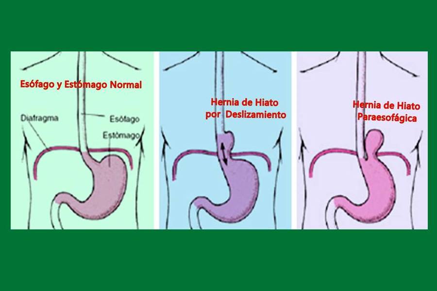 Síntomas de la hernia de Hiato, Tipos de hernia de hiato, hernia de hiato por deslizamiento, hernia de hiato paraesofágica, hernia hiatal,