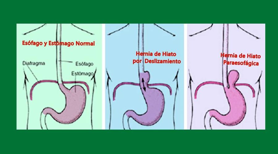 Hernia de Hiato, Hernia Hiatal, qué es la hernia de hiato, causas de la hernia de hiato, ¿a quién afecta la hernia de hiato?,